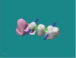 Th 3m Lava3unit Cant Bridge Th 3m Lava3unit Cant Bridge