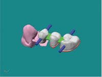 Th 3m Lava3unit Cant Bridge Th 3m Lava3unit Cant Bridge