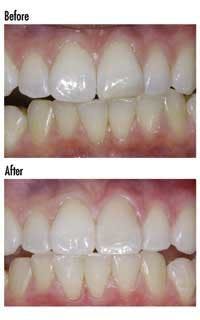 Th Cerec Replicabefore Th Cerec Replicabefore