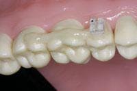 Th Everstick Anchorage Th Everstick Anchorage