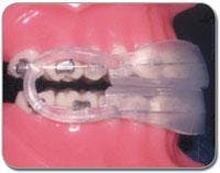 Th Masel Bite Appliance Th Masel Bite Appliance