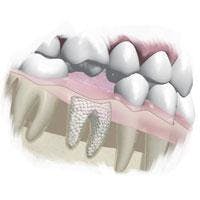 Th Ultradent Rootreplica Th Ultradent Rootreplica