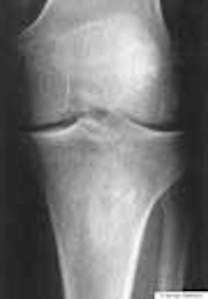 Tibia Fracture Fo