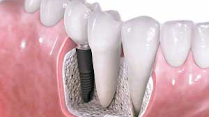 Tooth Implants Fo