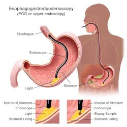 Ulcers Fo Ulcers Fo