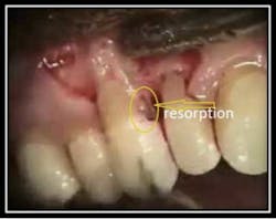 Uncovered Resorptin 6 Uncovered Resorptin 6