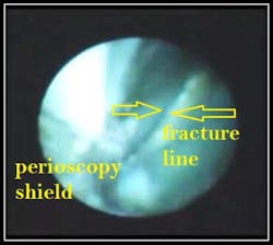 Vertical Root Fracture Fo Vertical Root Fracture Fo