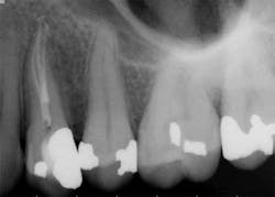 15apr2bclandwehr Rootcanals 03b 15apr2bclandwehr Rootcanals 03b