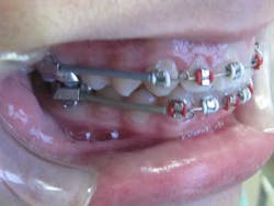 16jan7bcbunker06 16jan7bcbunker06