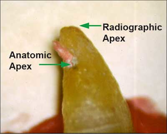 Endodontic insight Where should the guttapercha point end for optimal endodontic success