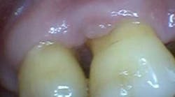 Content Dam Diq Online Articles 2016 01 1601clinlong Perio Diabetes Lanap Article Thumbnail Content Dam Diq Online Articles 2016 01 1601clinlong Perio Diabetes Lanap Article Thumbnail