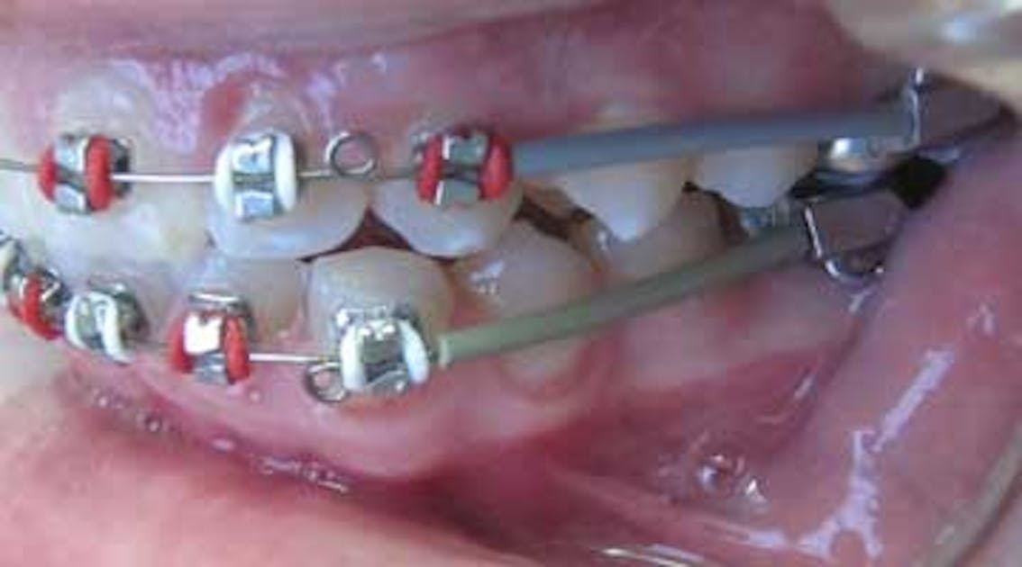 Rubber Bands Braces 101 - Orthodontics Limited