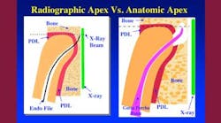 Content Dam Diq Online Articles 2016 01 16jan7bcdeutsch Gutta Percha Point Article Thumb Content Dam Diq Online Articles 2016 01 16jan7bcdeutsch Gutta Percha Point Article Thumb