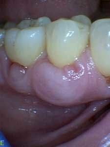 1601clinlong Perio Diabetes Lanap01 1601clinlong Perio Diabetes Lanap01