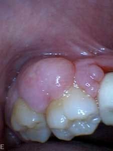 1601clinlong Perio Diabetes Lanap02 1601clinlong Perio Diabetes Lanap02