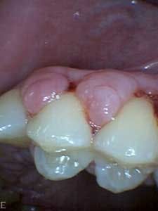 1601clinlong Perio Diabetes Lanap03 1601clinlong Perio Diabetes Lanap03