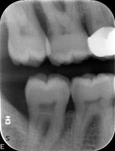 1601clinlong Perio Diabetes Lanap04 1601clinlong Perio Diabetes Lanap04