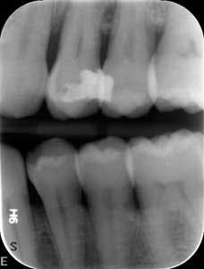 1601clinlong Perio Diabetes Lanap05 1601clinlong Perio Diabetes Lanap05