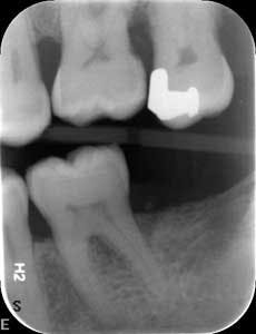 1601clinlong Perio Diabetes Lanap06 1601clinlong Perio Diabetes Lanap06