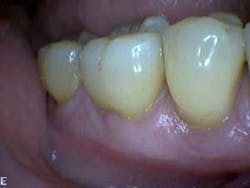 1601clinlong Perio Diabetes Lanap07 1601clinlong Perio Diabetes Lanap07