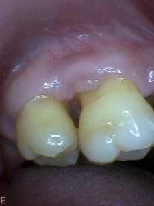 1601clinlong Perio Diabetes Lanap08 1601clinlong Perio Diabetes Lanap08