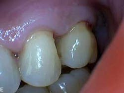 1601clinlong Perio Diabetes Lanap09 1601clinlong Perio Diabetes Lanap09