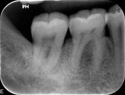 1601clinlong Perio Diabetes Lanap11 1601clinlong Perio Diabetes Lanap11