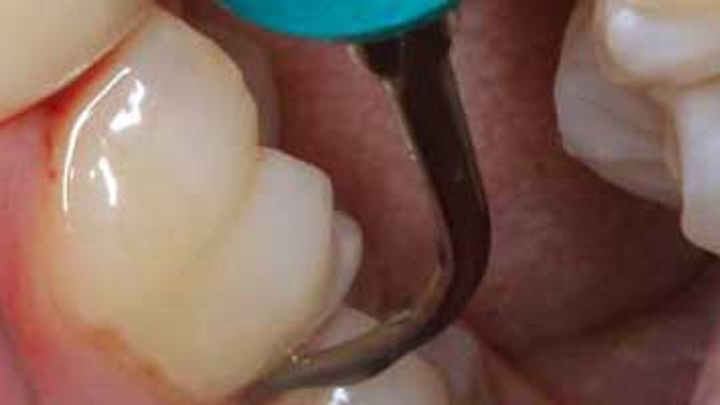 Content Dam Diq Online Articles 2016 02 16feb04bc Nonsurgical Perio Tx Article Thumbnail