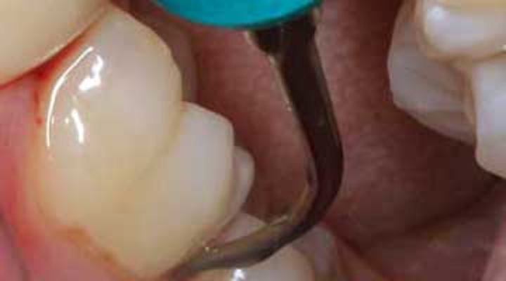 Nonsurgical Periodontal Disease Treatment The Periodontist S Point Of View Dentistryiq