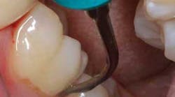 Content Dam Diq Online Articles 2016 02 16feb04bc Nonsurgical Perio Tx Article Thumbnail Content Dam Diq Online Articles 2016 02 16feb04bc Nonsurgical Perio Tx Article Thumbnail