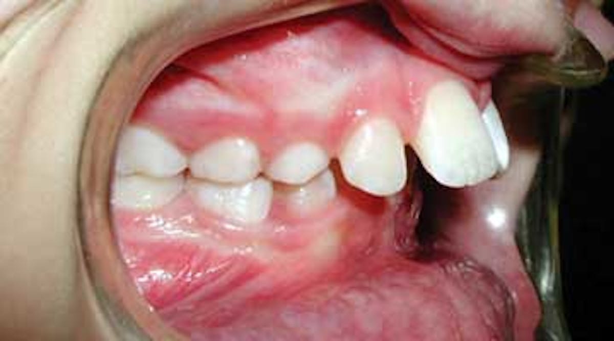 Content Dam Diq Online Articles 2016 02 Orthodontics Protrusion Article Thumbnail