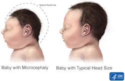 Microcephaly Comparison Microcephaly Comparison
