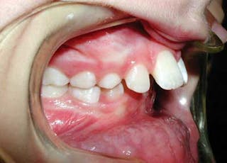 Orthodontics Protrusion