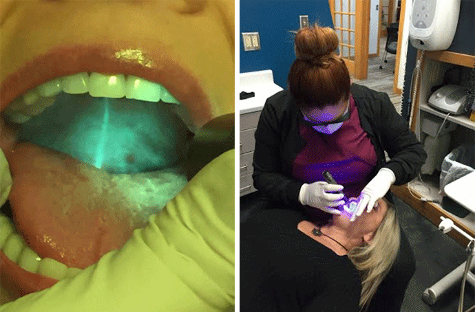 Staying Ahead Of The Grim Reaper Oral Cancer Screening Tools Can Help Save Lives Dentistryiq