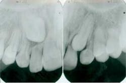 Figure 2: Severe root resorption evident on maxillary lateral incisors Figure 2: Severe root resorption evident on maxillary lateral incisors