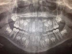 Figure 4a: Fixed lingual retainers placed from lateral incisor to lateral incisor Figure 4a: Fixed lingual retainers placed from lateral incisor to lateral incisor