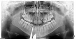 Figure 4b: Two years later, root resorption is evident on the maxillary left lateral incisor. Figure 4b: Two years later, root resorption is evident on the maxillary left lateral incisor.