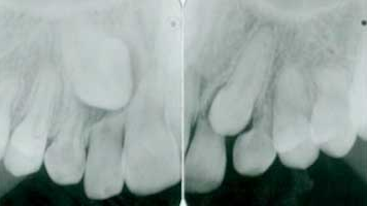 How To Prevent Root Resorption Using The Golden Rule Of Orthodontics Dentistryiq It is the visible portion of the tooth that protrudes from the gum. how to prevent root resorption using