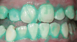 Content Dam Diq Online Articles 2016 03 Plaque Hd Teeth Enl Content Dam Diq Online Articles 2016 03 Plaque Hd Teeth Enl