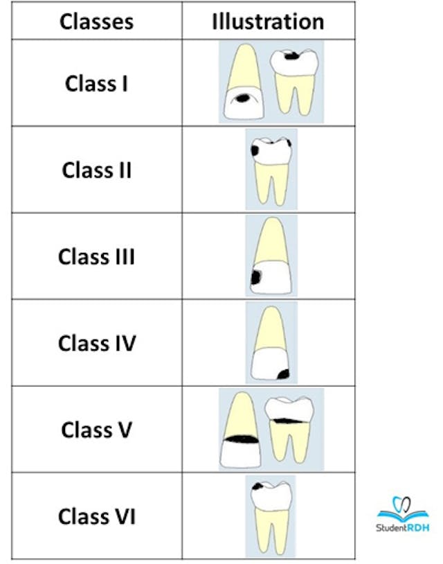 G.V. BLACK'S CLASSIFICATION OF CARIES