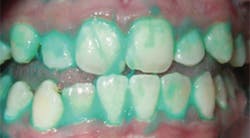 Plaque Hd Teeth Plaque Hd Teeth