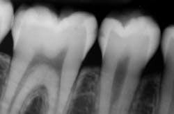 Questionsaboutcariesxraymsh Questionsaboutcariesxraymsh