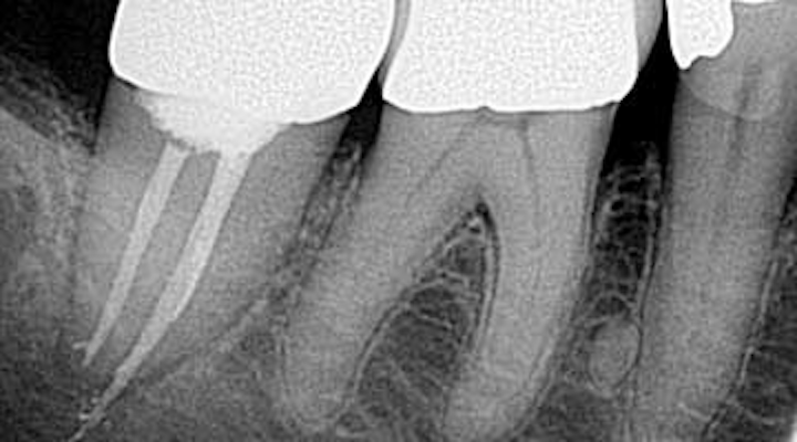 Oops Mishaps And Prevention Guidelines For Your Endodontics Procedures Dentistryiq
