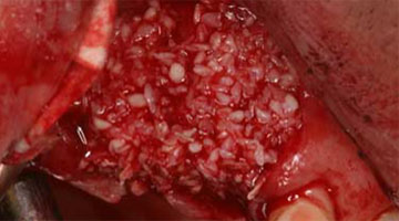 Content Dam Diq Online Articles 2016 04 Bone Graft 1