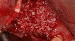 Content Dam Diq Online Articles 2016 04 Bone Graft 1 Content Dam Diq Online Articles 2016 04 Bone Graft 1