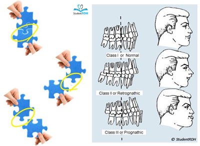 Occlusionmsh