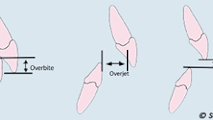Overjetoverbiteopenbitemsh