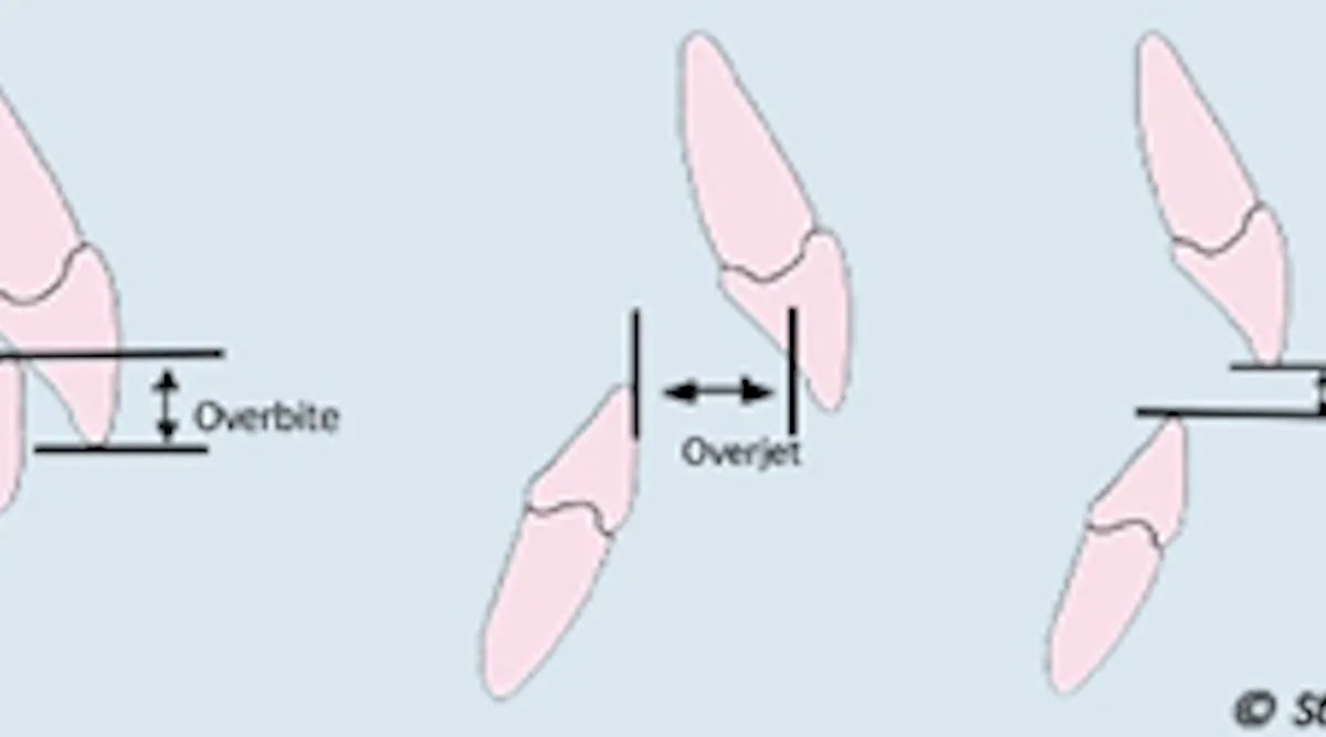 Over Byte Classifying occlusion: Board exam tips from StudentRDH.com | Dentistry IQ