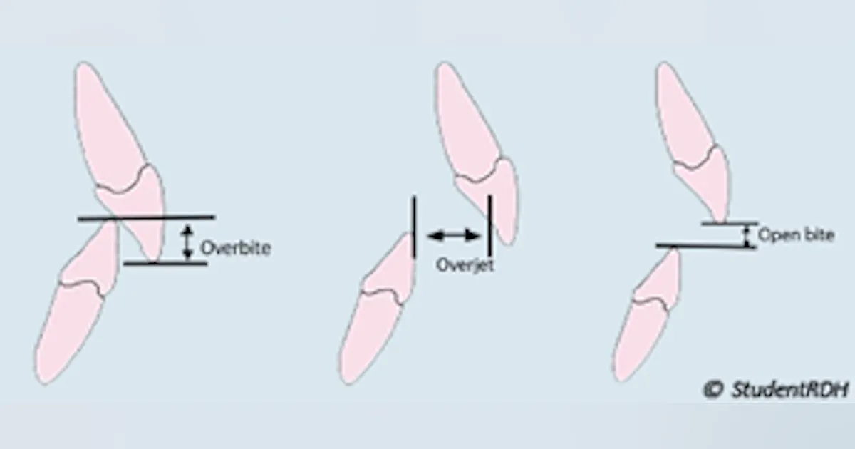 Over Byte Classifying occlusion: Board exam tips from StudentRDH.com | Dentistry IQ