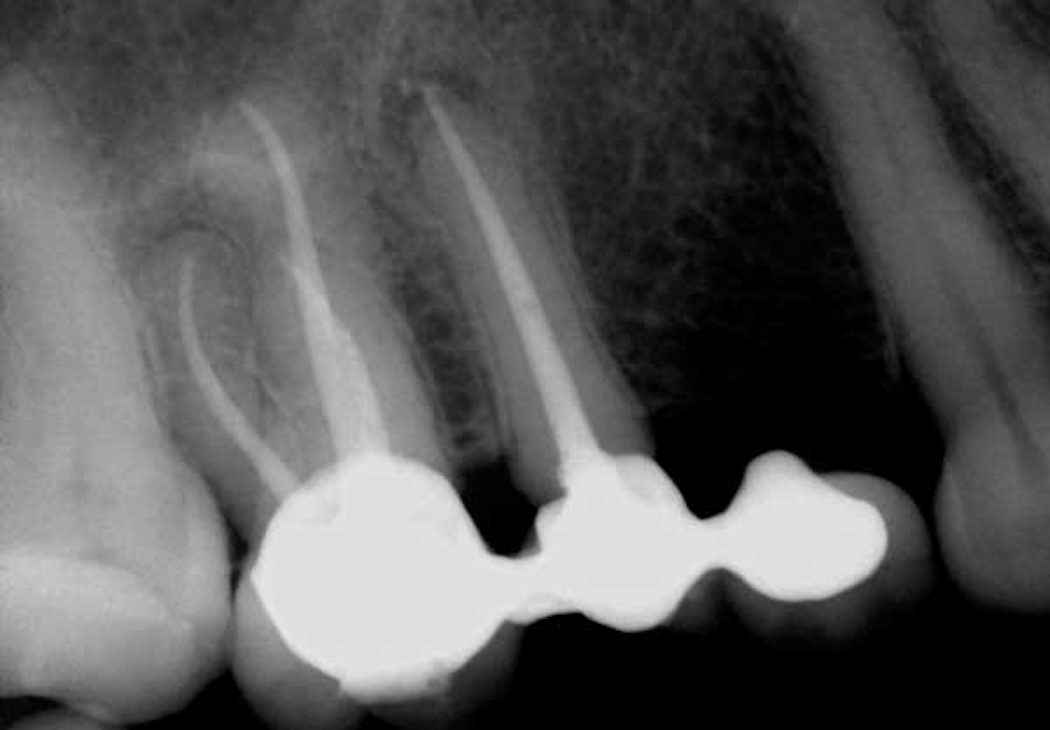 An Endodontist Answers 8 Questions Gps Ask About Root Canal Treatment Dentistry Iq